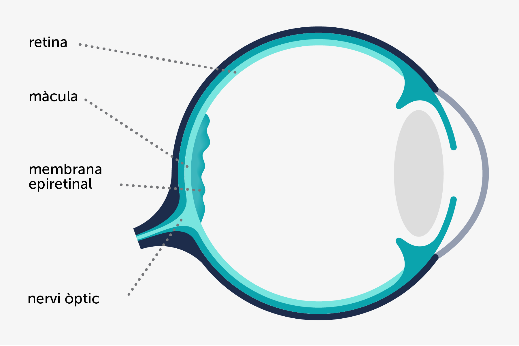 Infografia il·lustrada que mostra diferents parts involucrades en el desenvolupament de membrana epiretinal macular.