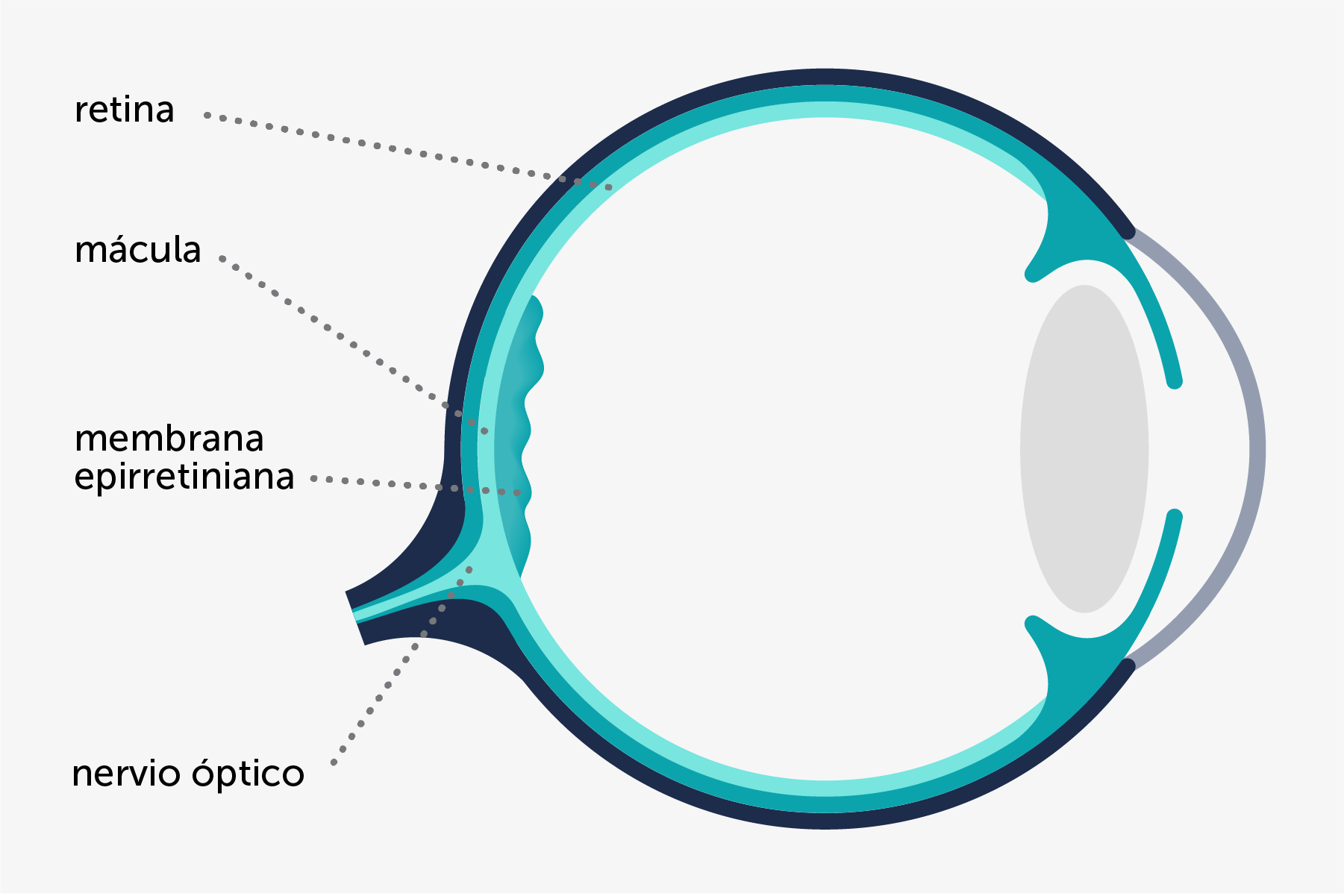 Infografía de la membrana epirretiniana macular, indicando dónde se sitúa en el ojo.