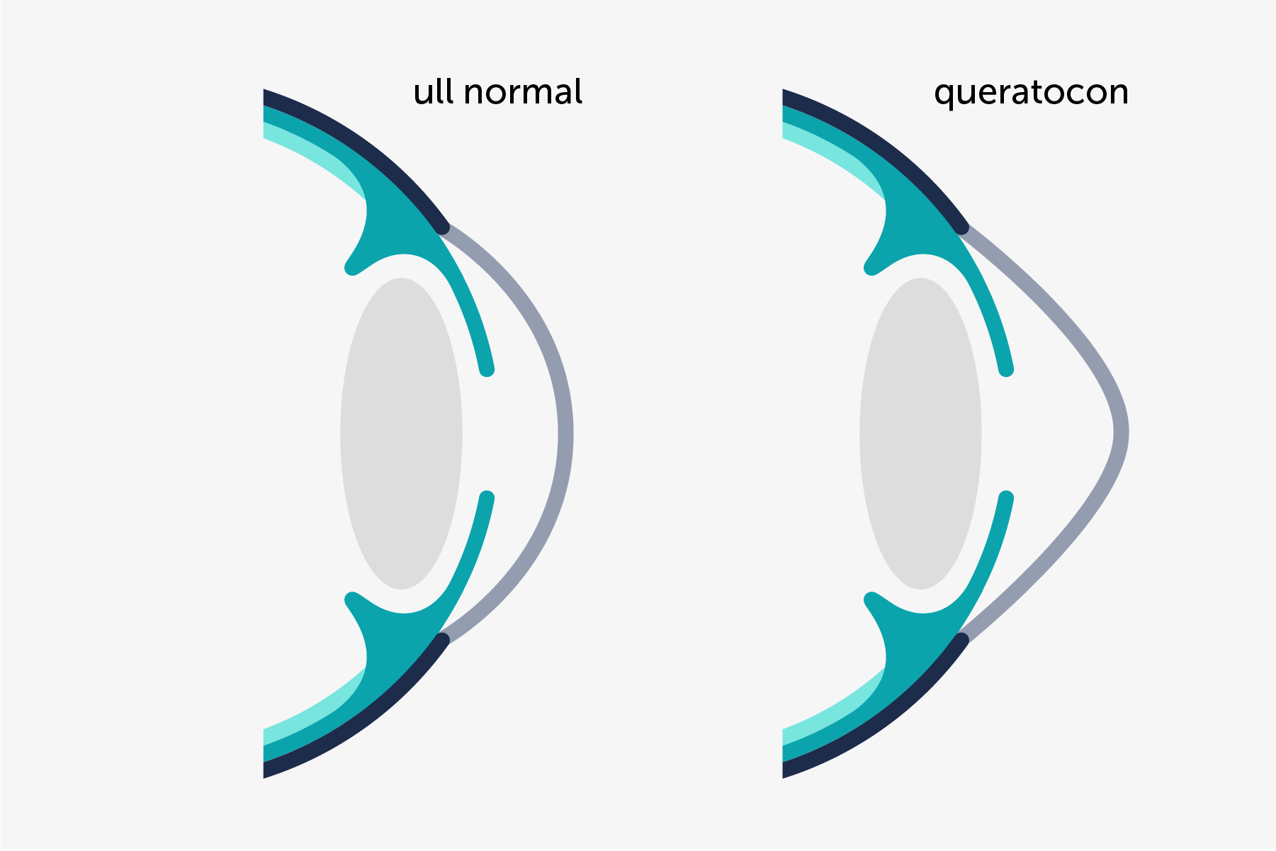 Infografia il·lustrativa del perfil d'un ull amb queratocon comparat amb un perfil de còrnia habitual (esfèrica).