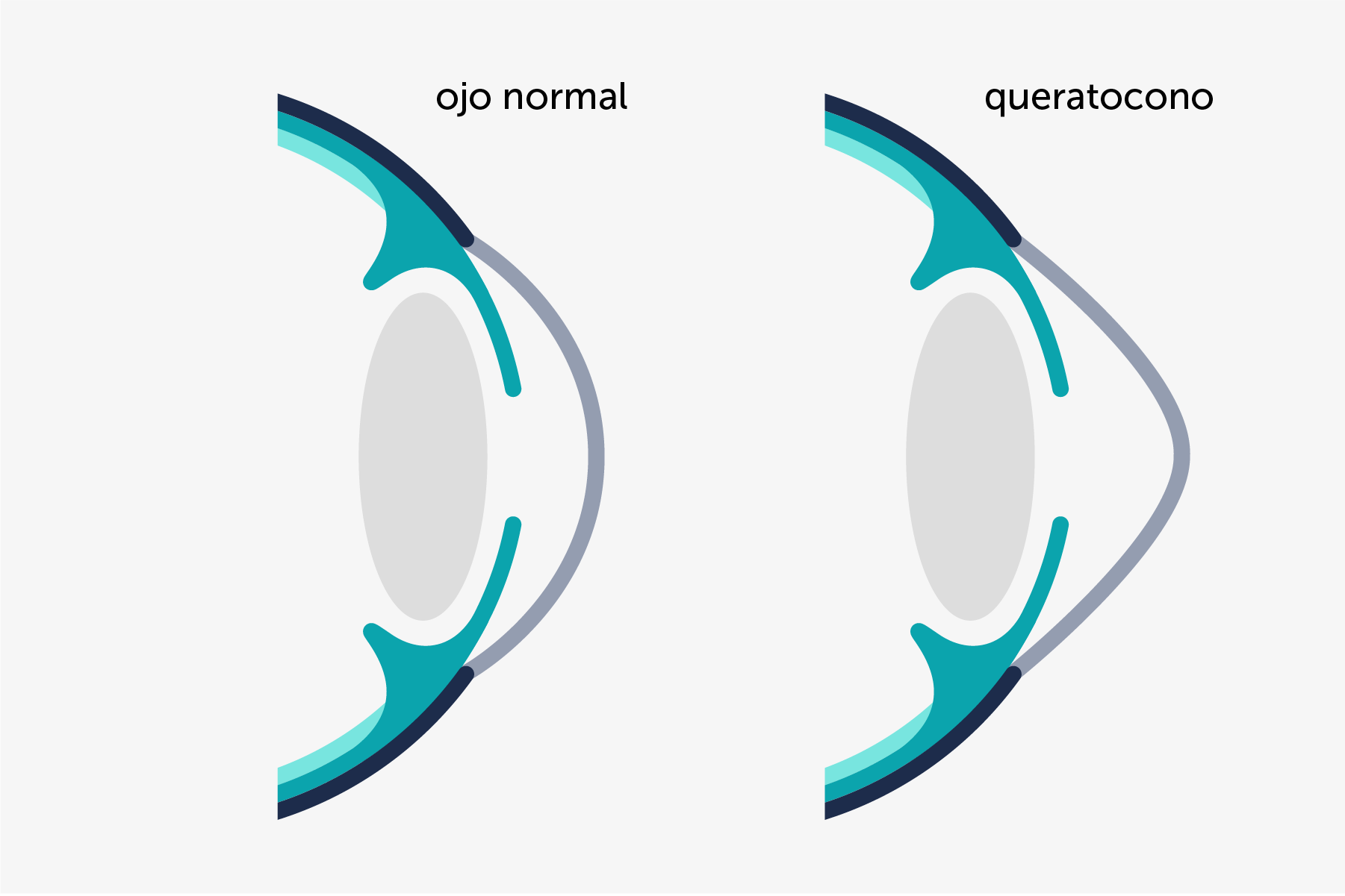 Infografía ilustrada comparando un ojo con queratocono y un ojo sano, con la córnea esférica.