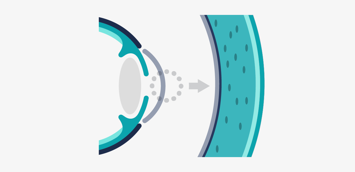 Ilustración esquemática representando algunas distrofias corneales, con un aumento en detalle de la parte de la córnea.