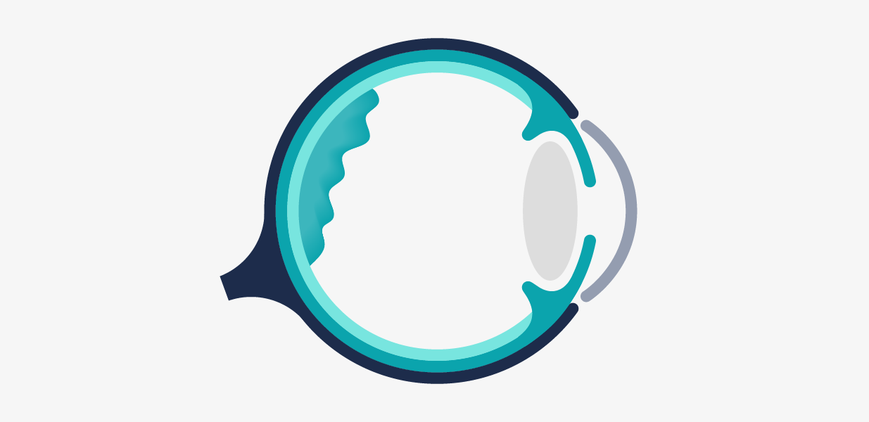 Il·lustració esquemàtica d'un ull amb membrana epiretinal macular.