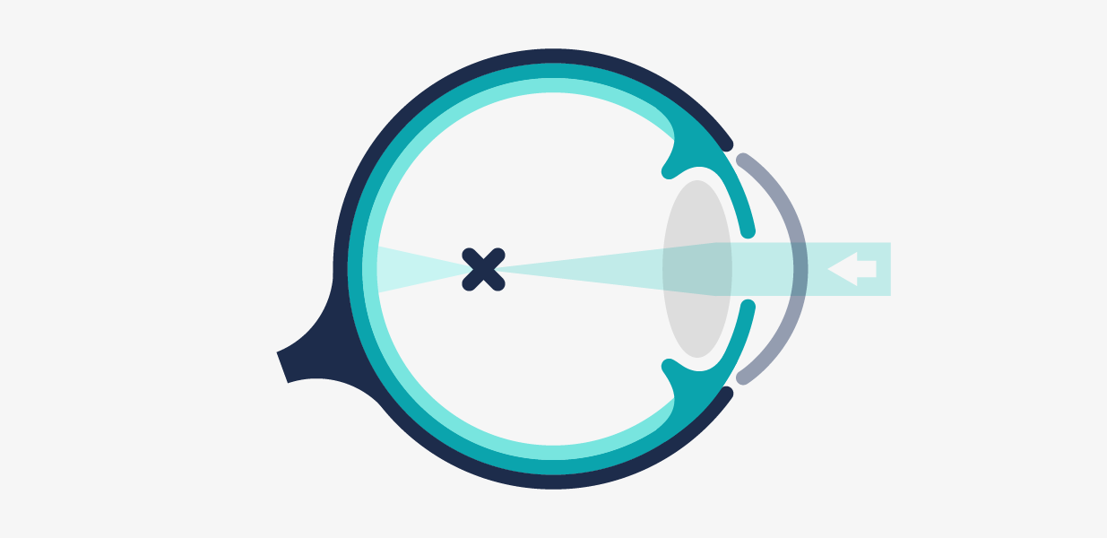 Ilustración esquemática de un ojo con miopía.