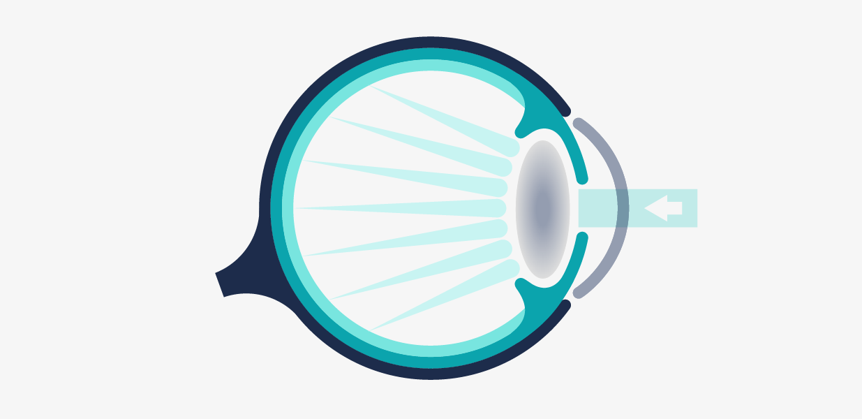 Il·lustració esquemàtica de la cataracta a l'ull