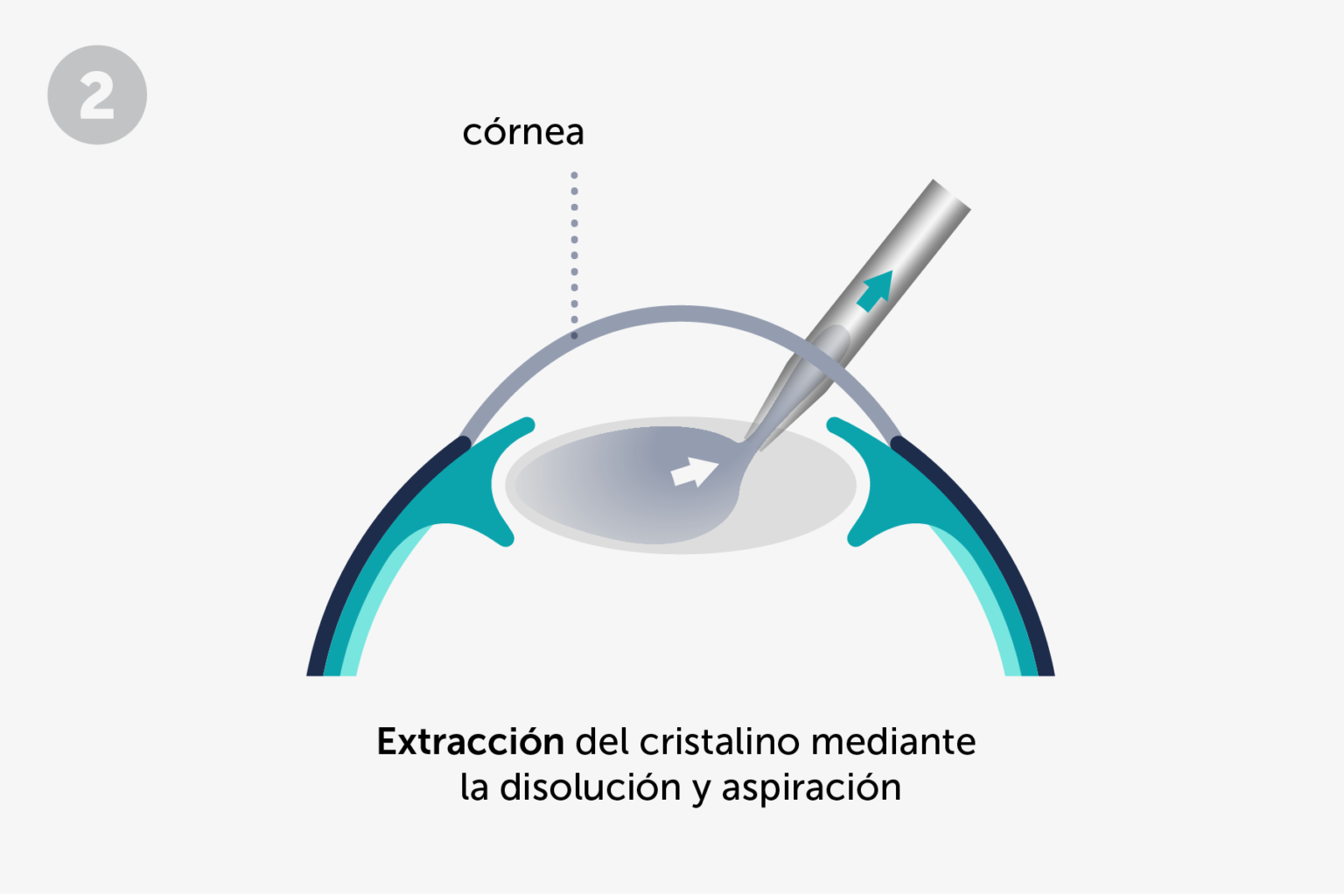 Operación de cataratas: ¿En qué consiste? | ICR Barcelona