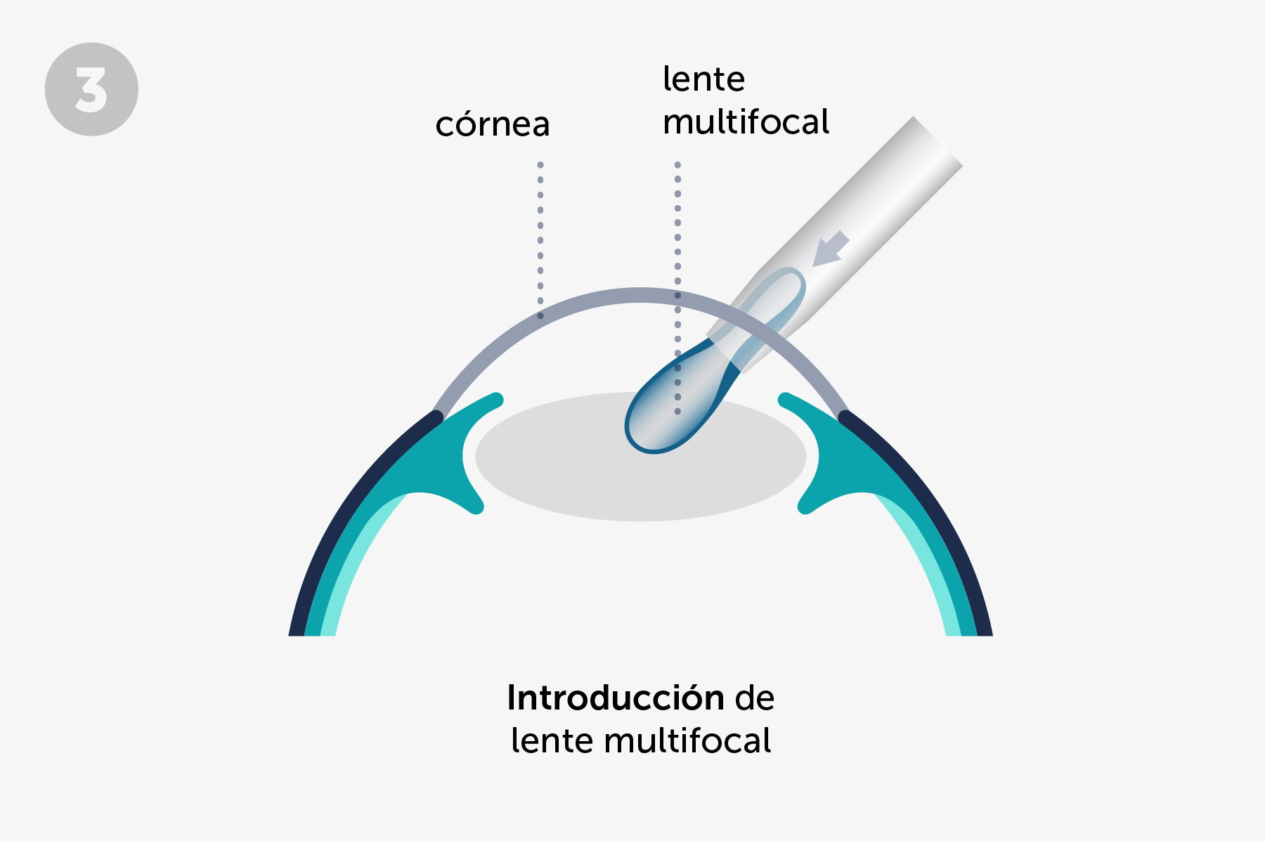 introducción de lente multifocal