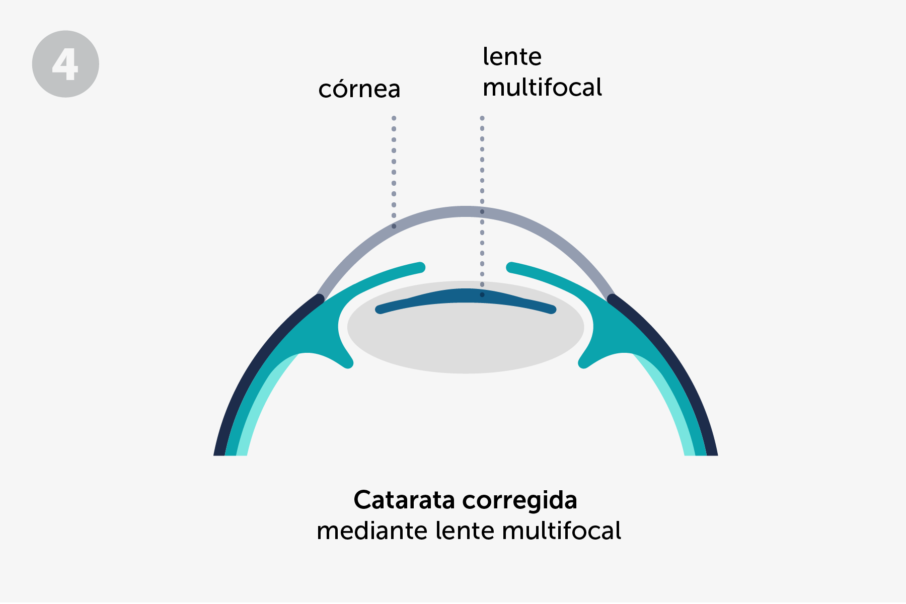 catarata corregida con lente multifocal