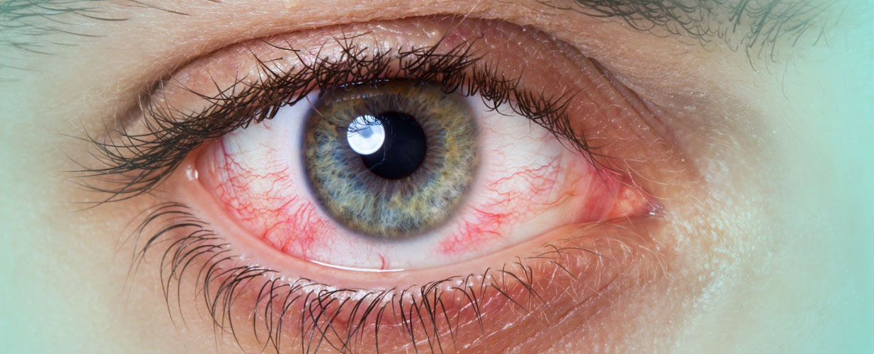 el enrojecimiento del ojo es un síntoma de la conjuntivitis