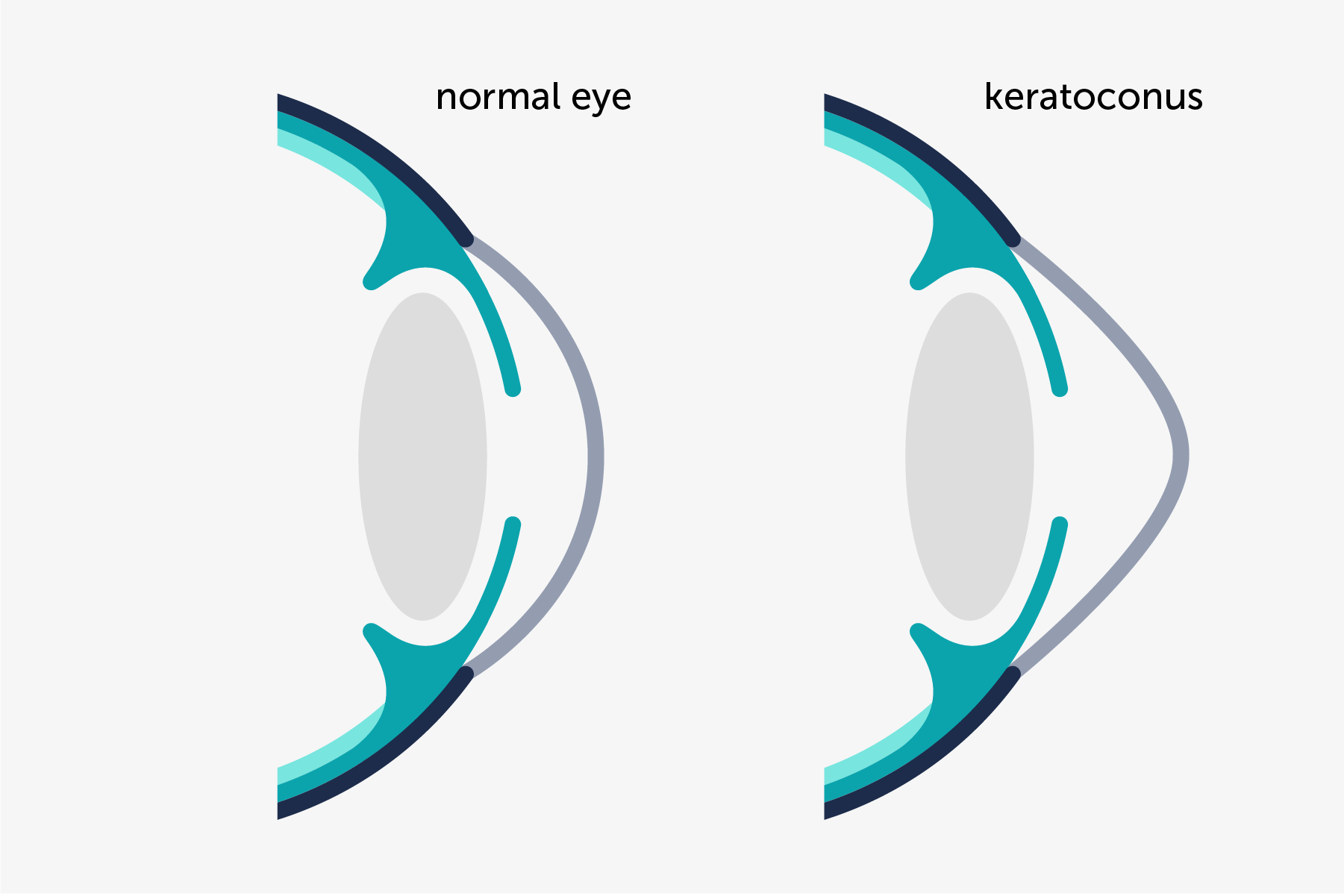 Illustration of the profile of a normal cornea and a cornea witrh keratoconus, a comparison.