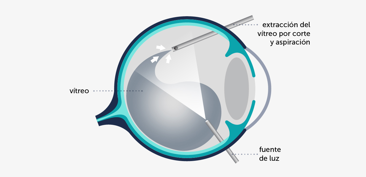 Ilustración esquemática del ojo intervenido de vitrectomía
