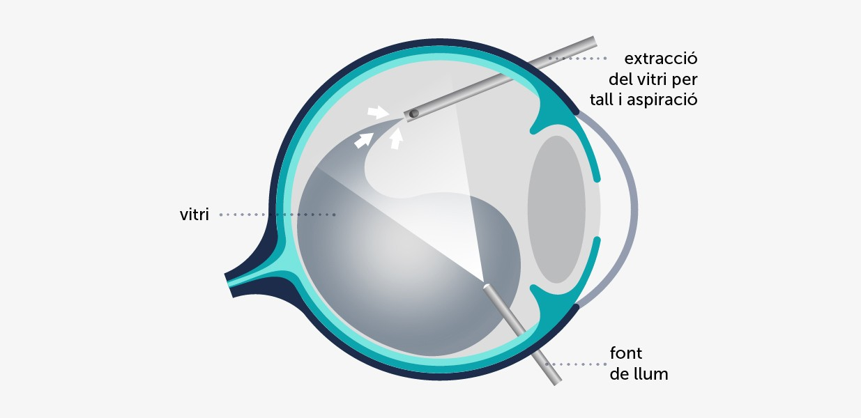 Il·lustració esquemàtica de la vitrectomia