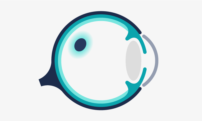 Esquema d'un forat macular