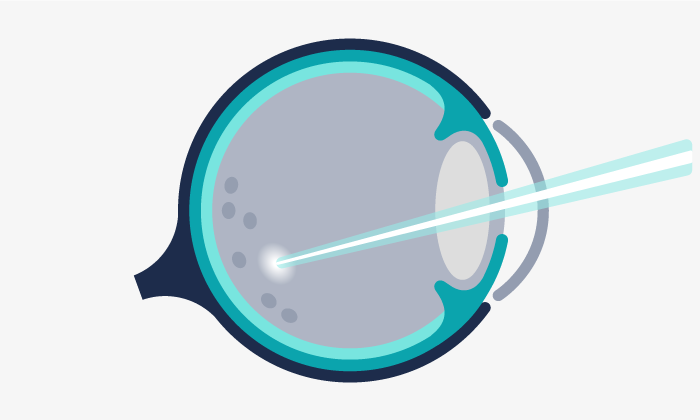 Photocoagulation au laser