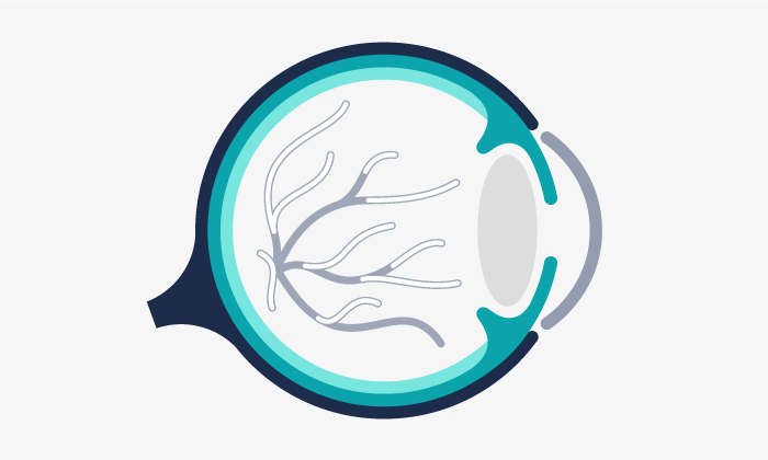 Oclusiones u obstrucciones de las venas y arterias de la retina