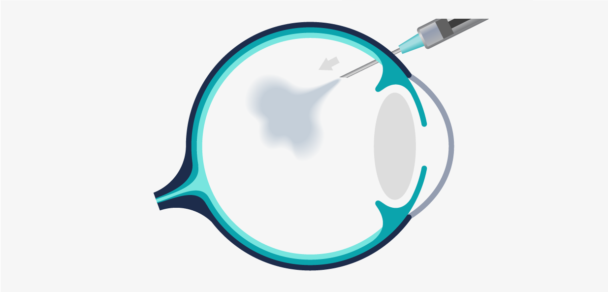 Intravitreal Injection