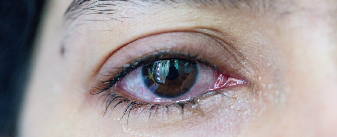 El ojo rojo es un síntoma que se puede presentar en uveítis o conjuntivitis